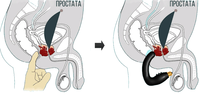 kak-dejstvuet-prostata-help-mp-1