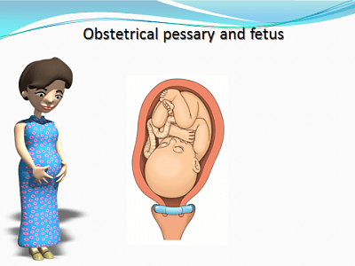 Как предотвратить прерывание беременности?
